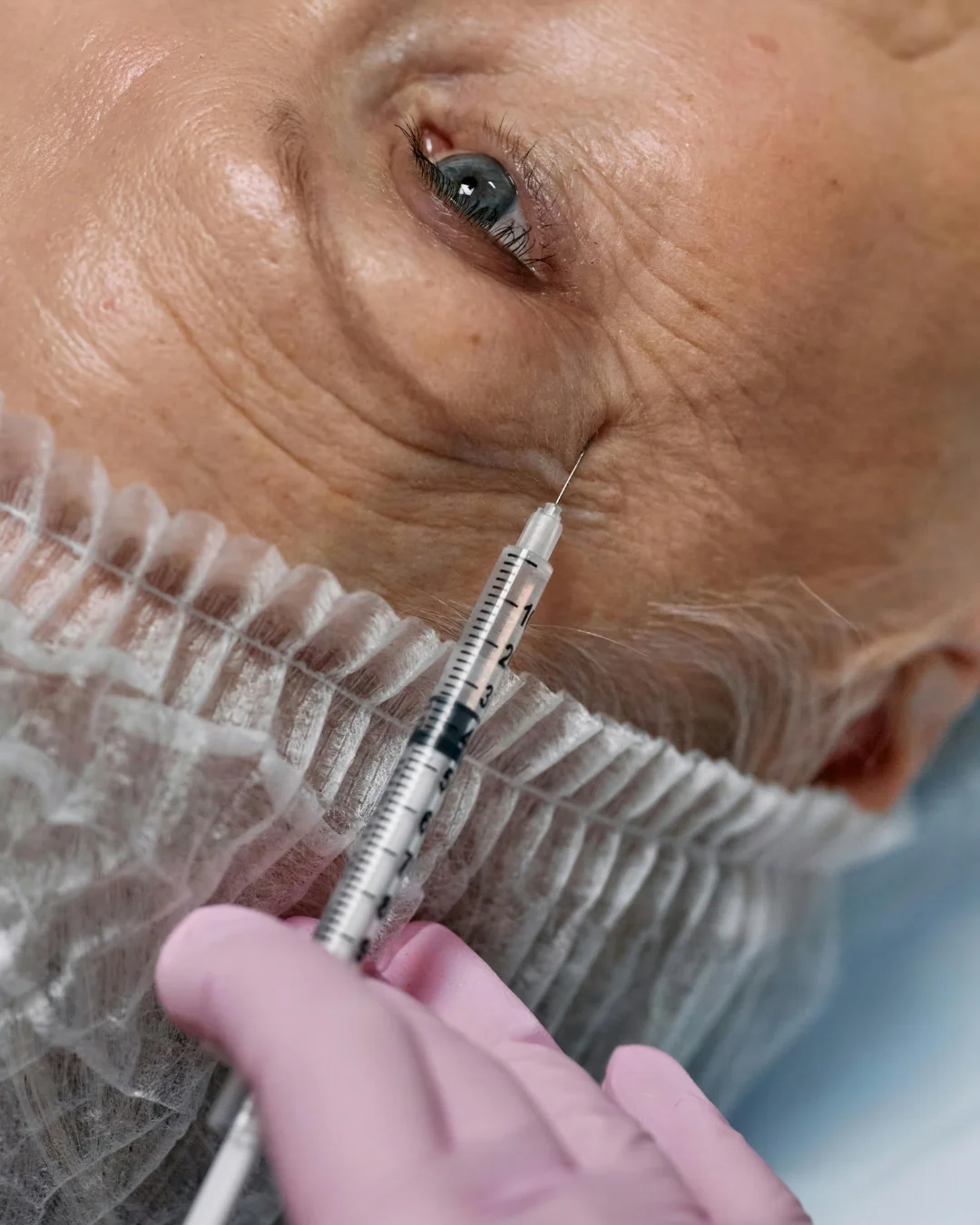Close-up of Botox injection for fine lines around the eyes