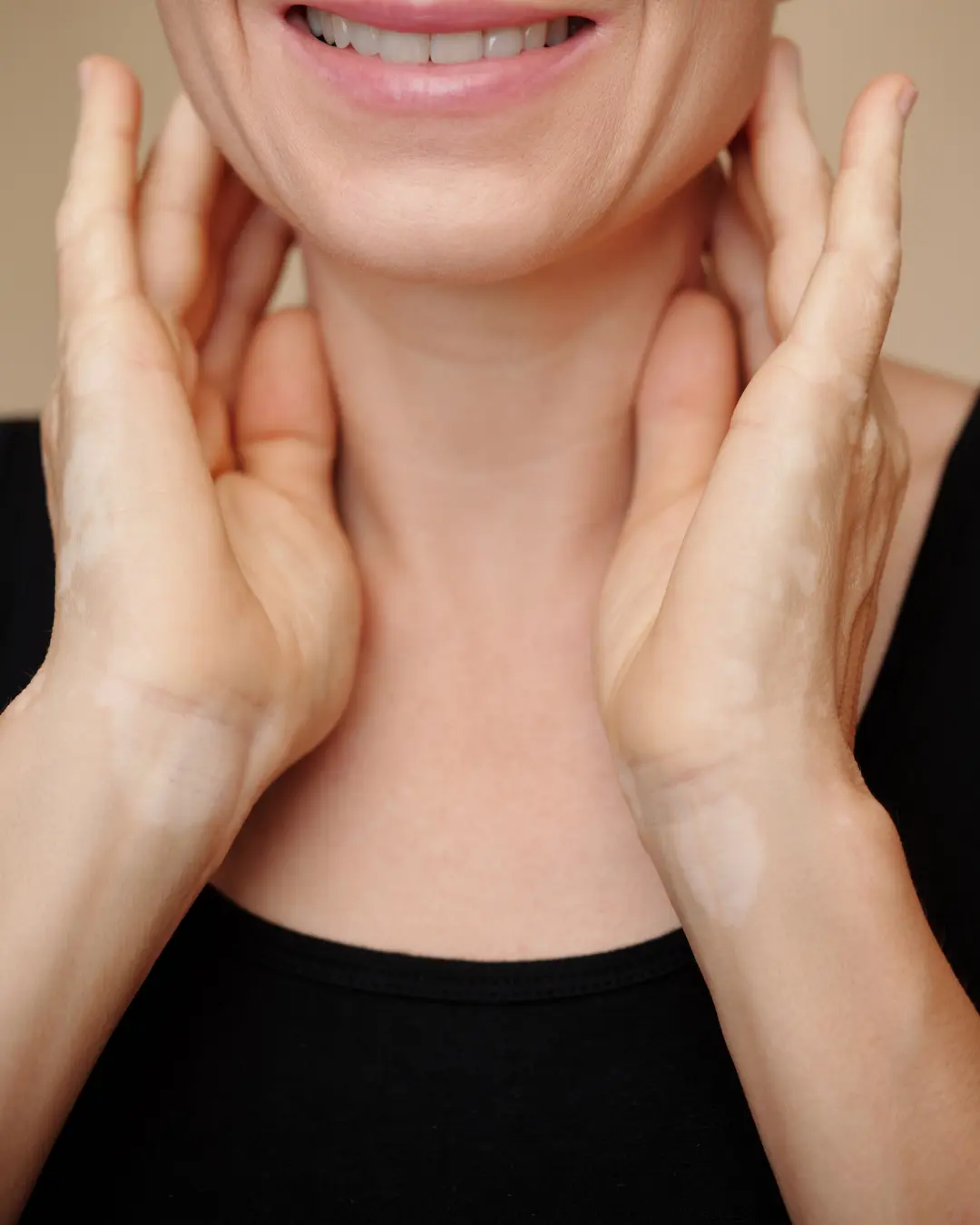 Neck bands Botox treatment