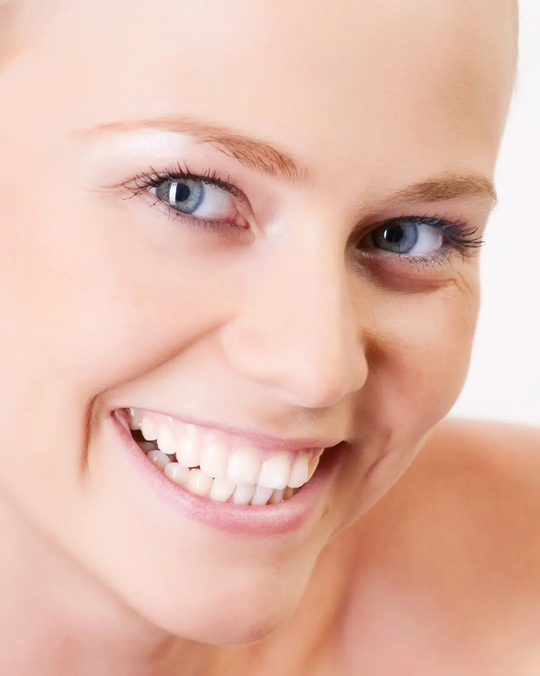 Gummy smile Botox correction