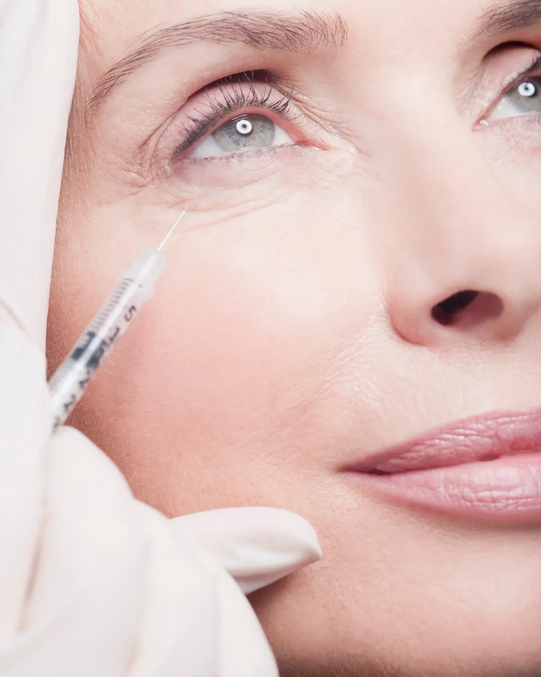 Under-eye tear trough rejuvenation