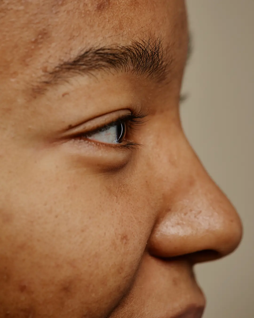 Microneedling for acne scars