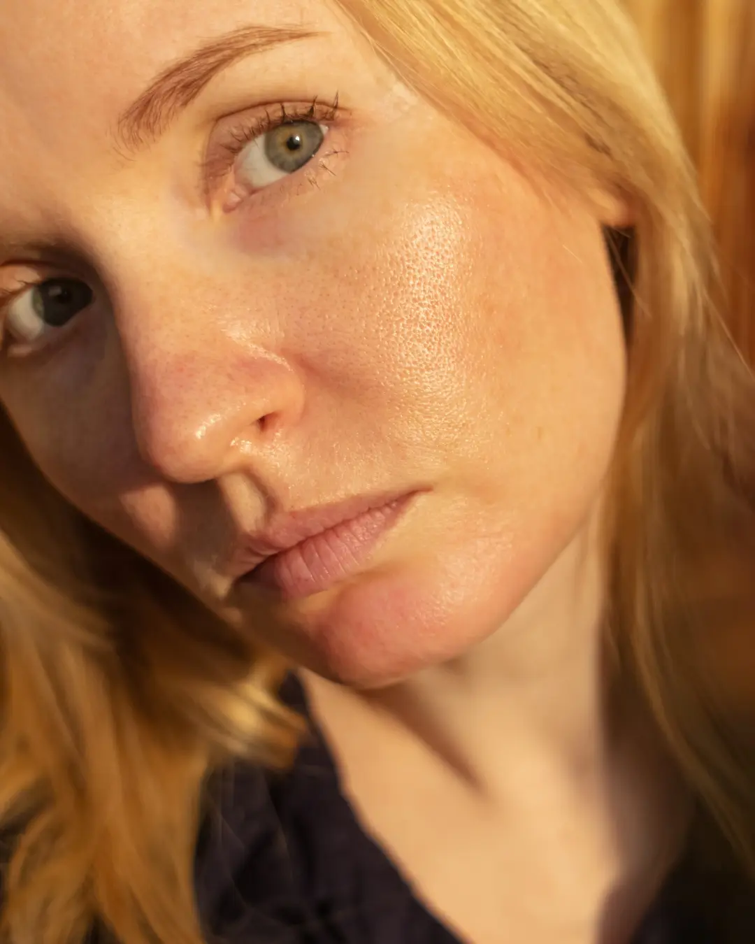 Pore-refining microneedling session