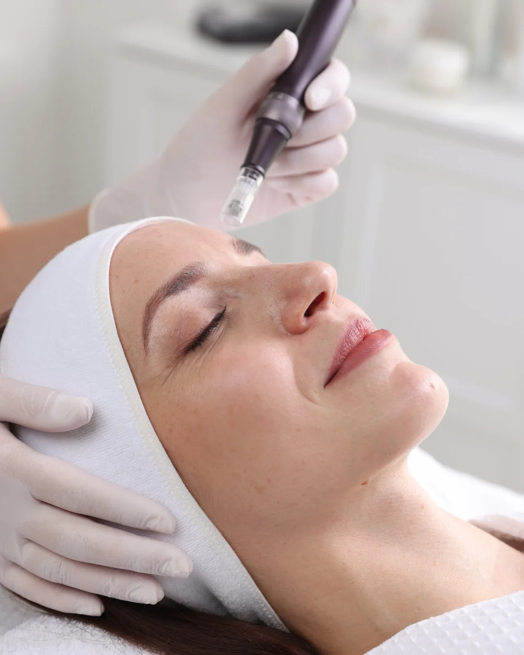 Microneedling at Healthy Minds Luxury Med Spa