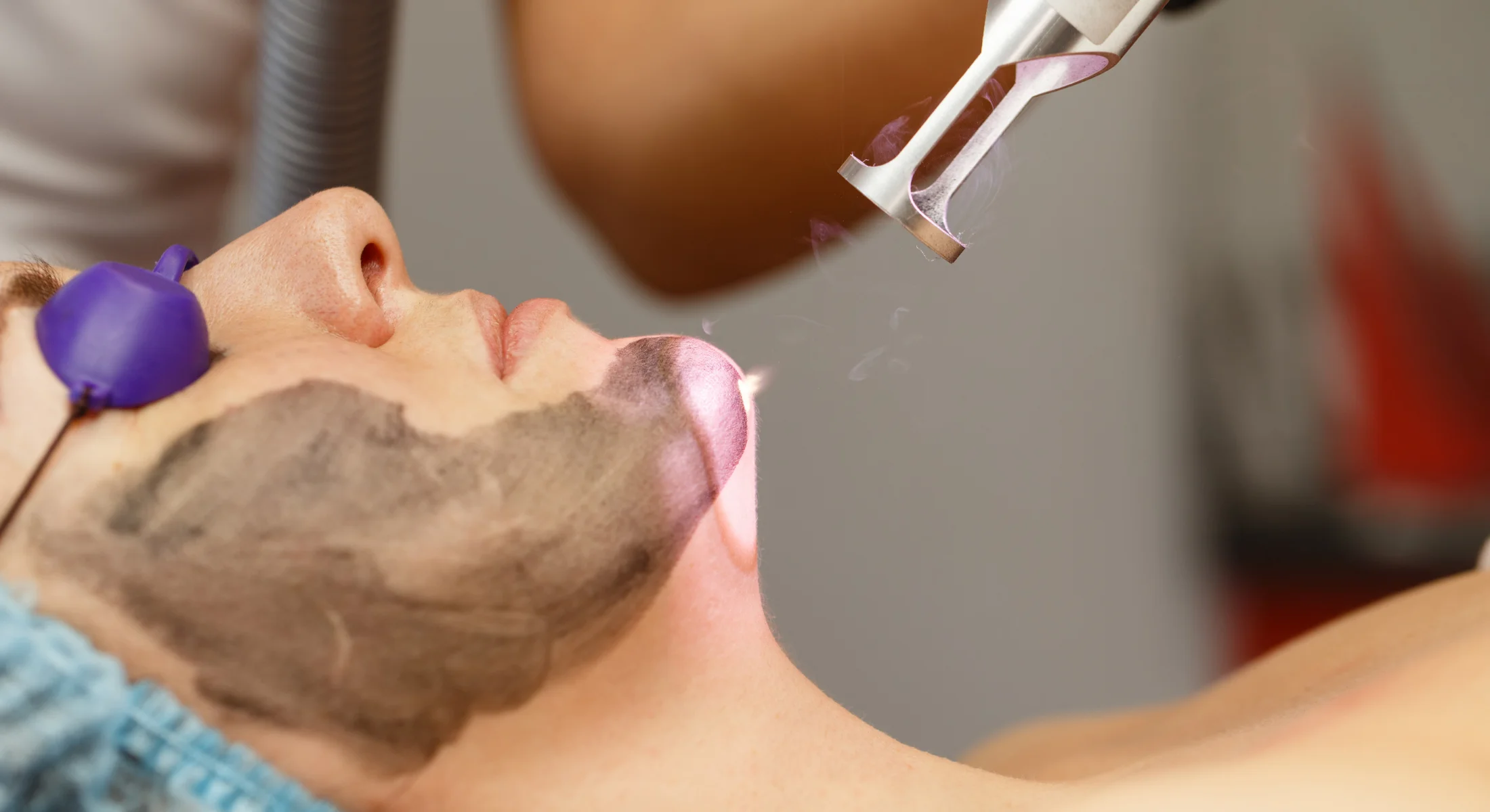 Hollywood Carbon Laser Facial