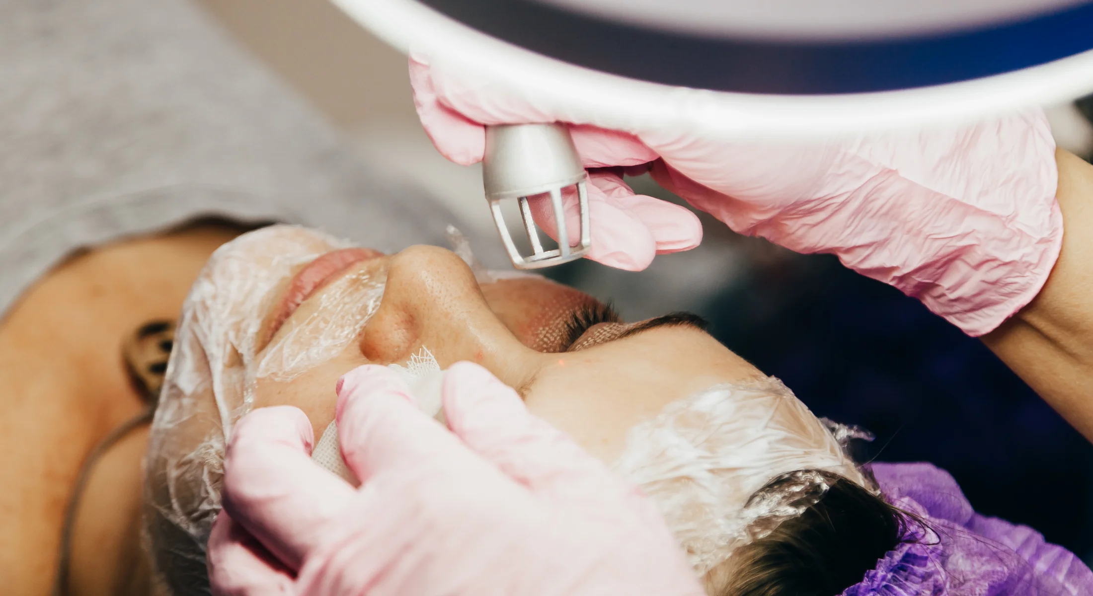 Acne scar laser treatment