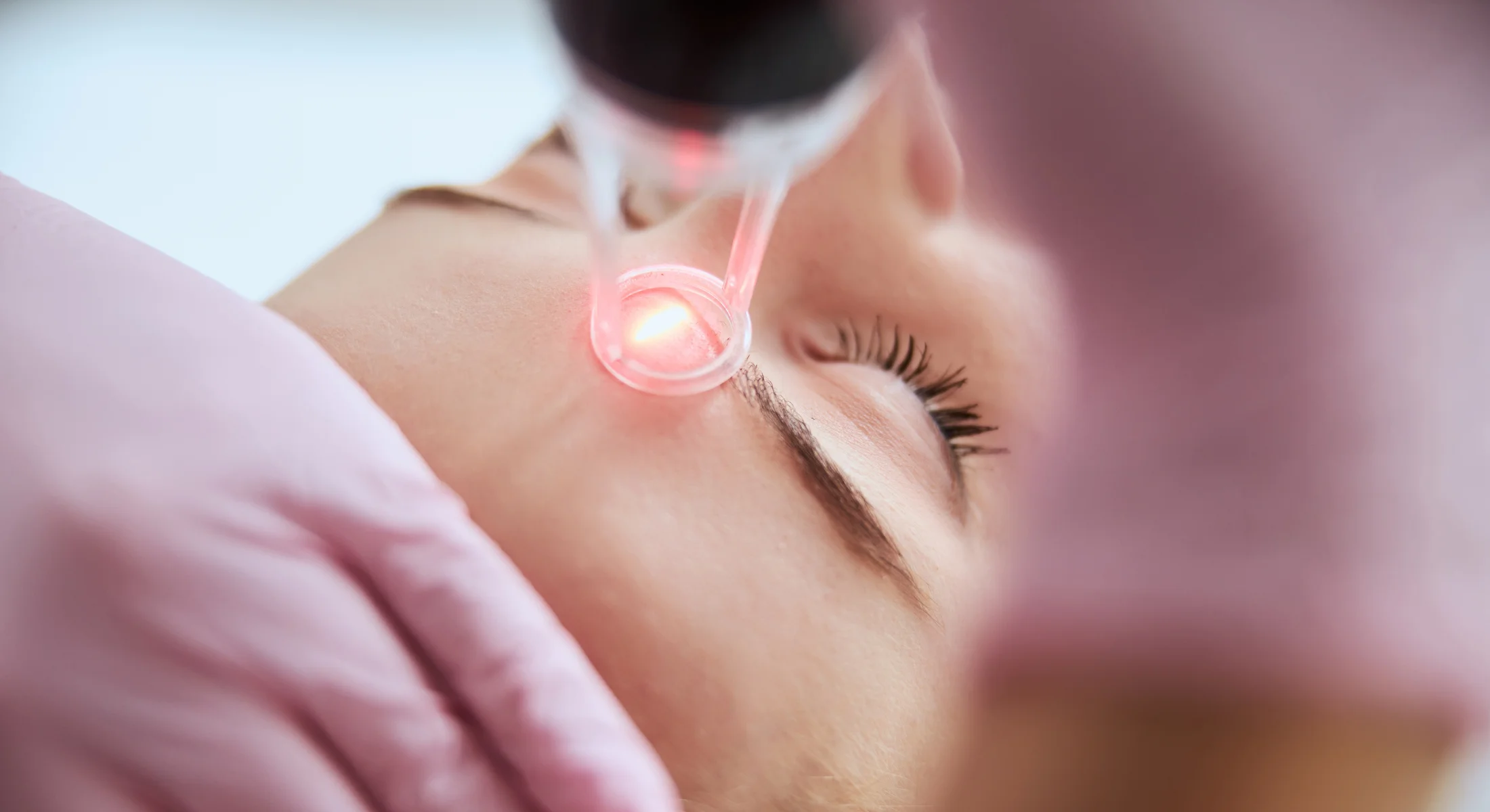 Pigmented lesion laser treatment